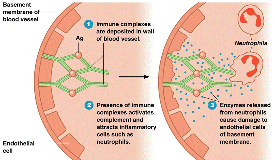 Ipersensibilità di Tipo III REAZIONI LOCALI: da immunocomplessi deposizione di immunocomplessi nei tessuti REAZIONI SISTEMICHE: