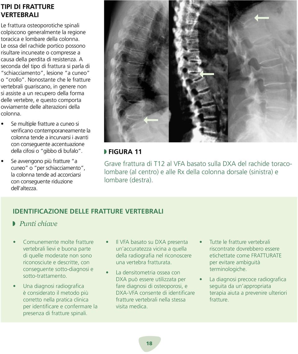 Nonostante che le fratture vertebrali guariscano, in genere non si assiste a un recupero della forma delle vertebre, e questo comporta ovviamente delle alterazioni della colonna.