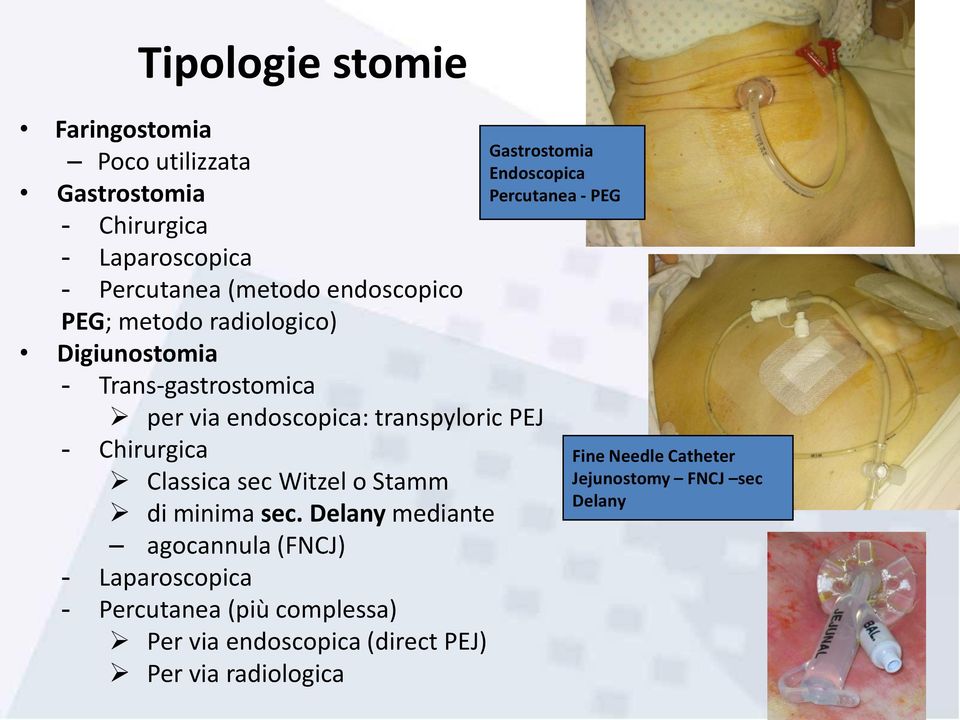 endoscopica: transpyloric PEJ - Chirurgica Classica sec Witzel o Stamm di minima sec.
