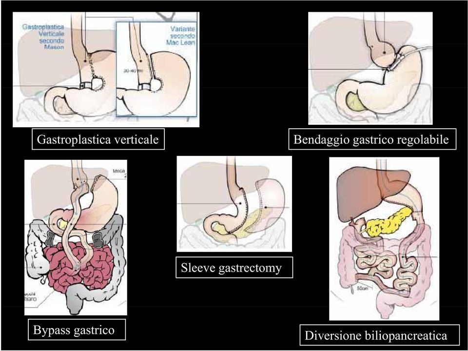 Sleeve gastrectomy Bypass