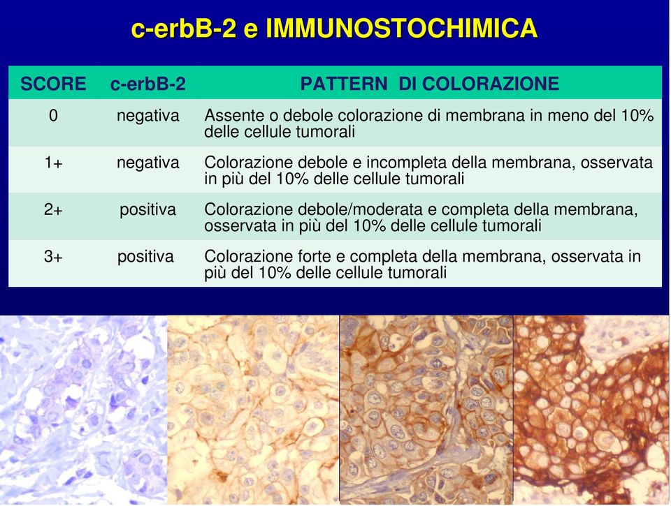 delle cellule tumorali 2+ positiva Colorazione debole/moderata e completa della membrana, osservata in più del 10% delle