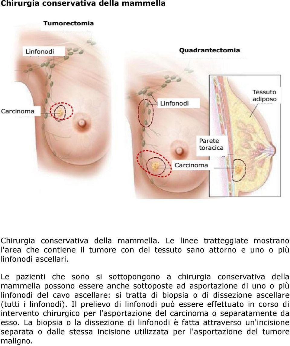 Le pazienti che sono si sottopongono a chirurgia conservativa della mammella possono essere anche sottoposte ad asportazione di uno o più linfonodi del cavo ascellare: si tratta di