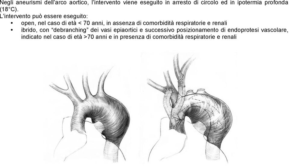 L intervento può essere eseguito: open, nel caso di età < 70 anni, in assenza di comorbidità