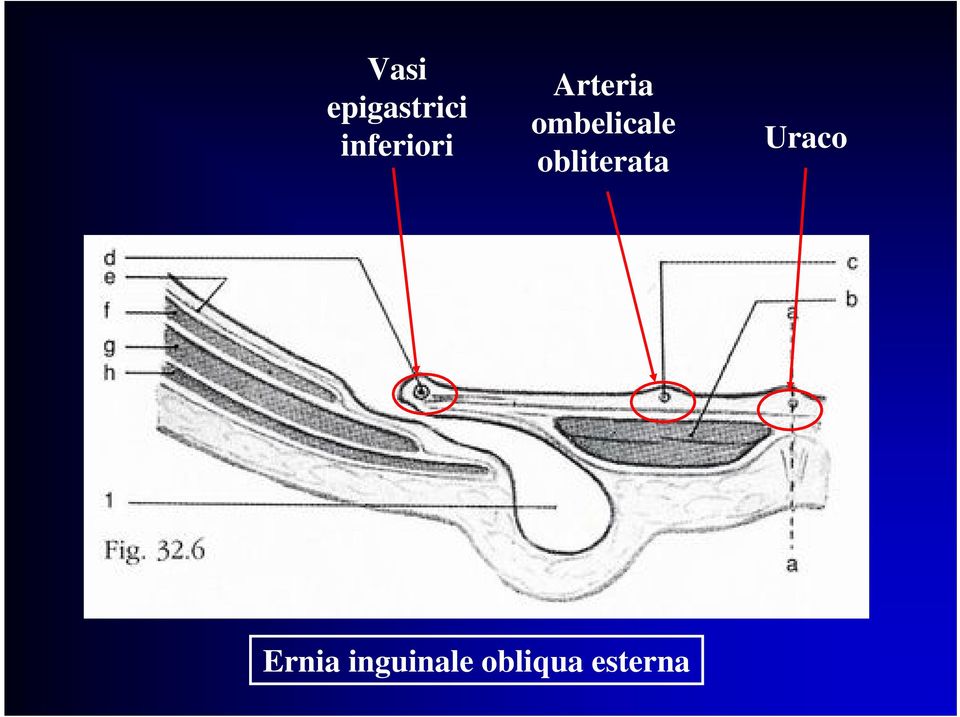 ombelicale obliterata