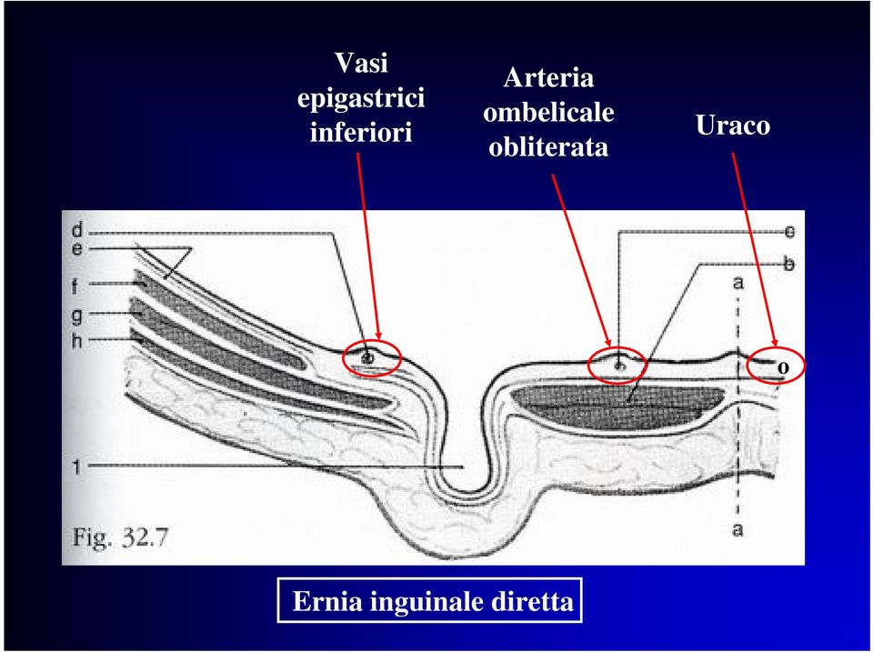 ombelicale obliterata