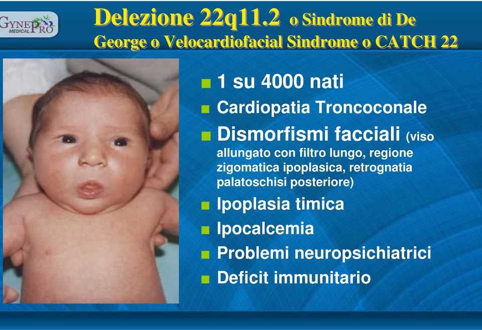 Cardiopatia Troncoconale Dismorfismi facciali (viso allungato con filtro lungo,