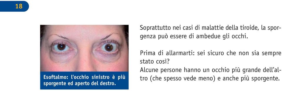 Esoftalmo: l'occhio sinistro è più sporgente ed aperto del destro.