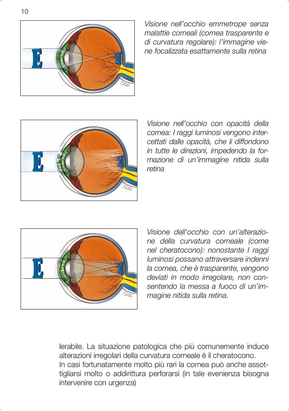 della curvatura corneale (come nel cheratocono): nonostante I raggi luminosi possano attraversare indenni la cornea, che è trasparente, vengono deviati in modo irregolare, non consentendo la messa a