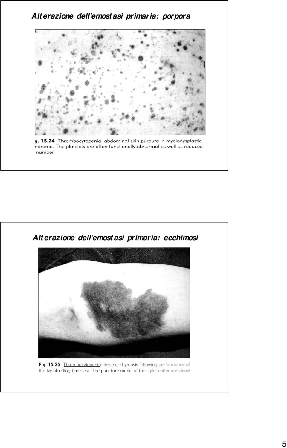 porpora   ecchimosi 5