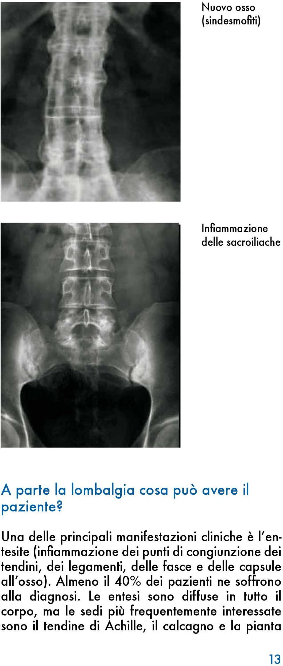 legamenti, delle fasce e delle capsule all osso). Almeno il 40% dei pazienti ne soffrono alla diagnosi.