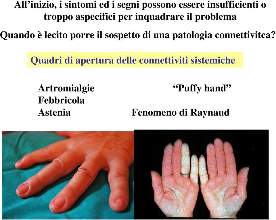 di una patologia connettivitca?