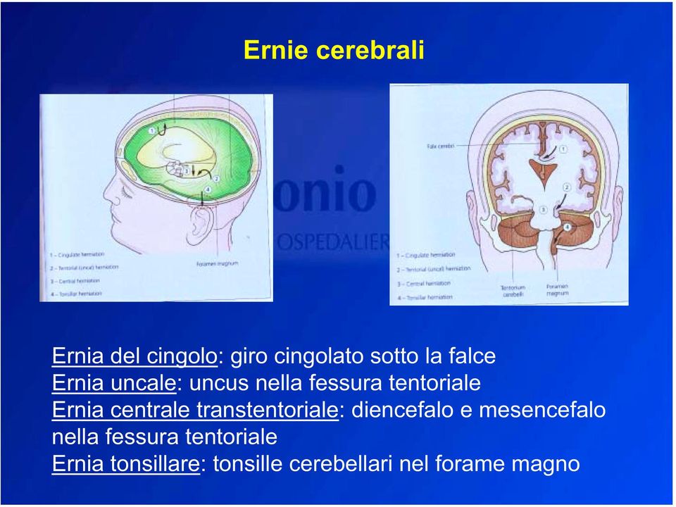 centrale transtentoriale: diencefalo e mesencefalo nella