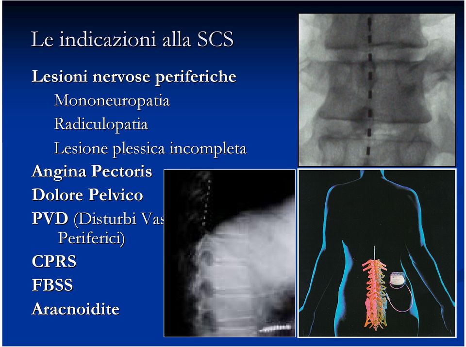 plessica incompleta Angina Pectoris Dolore