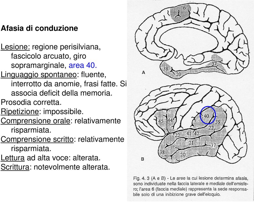 Si associa deficit della memoria. Prosodia corretta. Ripetizione: impossibile.