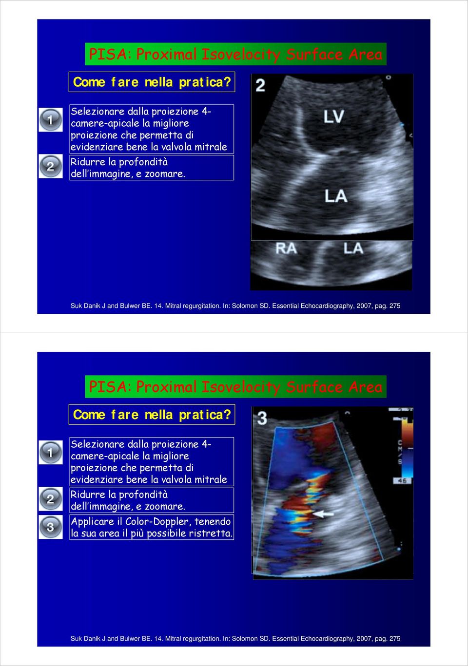 Suk Danik J and Bulwer BE. 14. Mitral regurgitation. In: Solomon SD. Essential Echocardiography, 2007, pag. 275   Applicare il Color-Doppler, tenendo la sua area il più possibile ristretta.