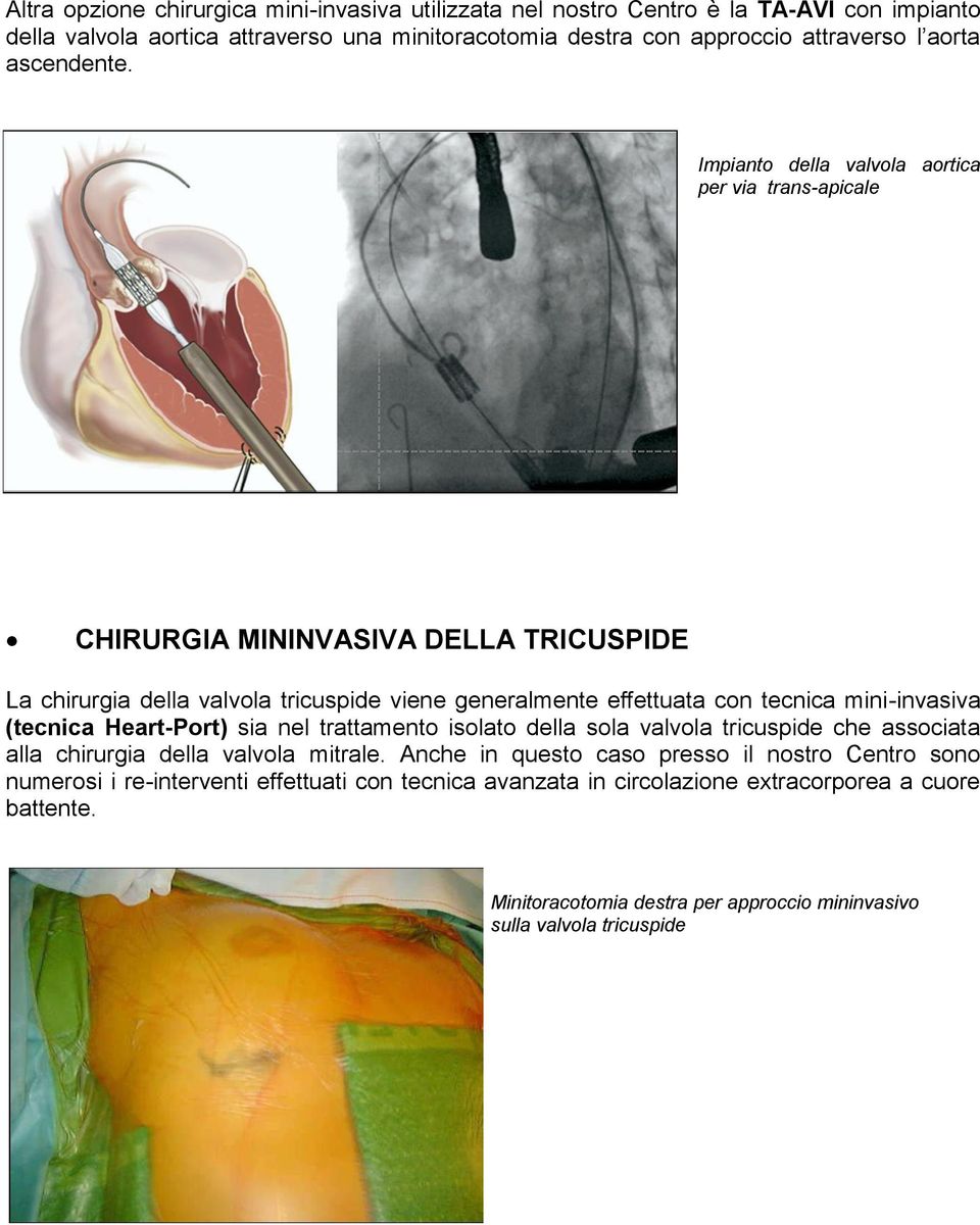 Impianto della valvola aortica per via trans-apicale CHIRURGIA MININVASIVA DELLA TRICUSPIDE La chirurgia della valvola tricuspide viene generalmente effettuata con tecnica mini-invasiva