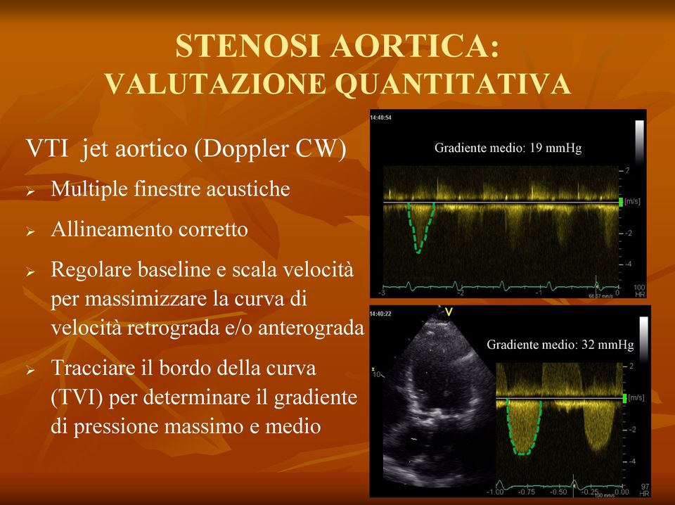 per massimizzare la curva di velocità retrograda e/o anterograda Tracciare il bordo della