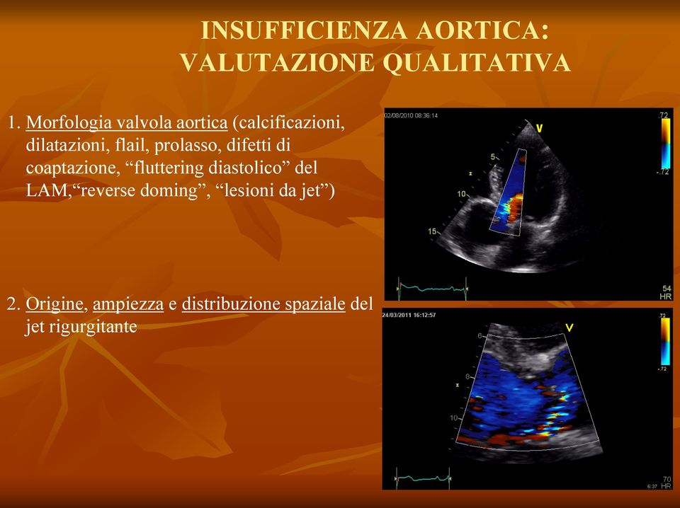 prolasso, difetti di coaptazione, fluttering diastolico del LAM,