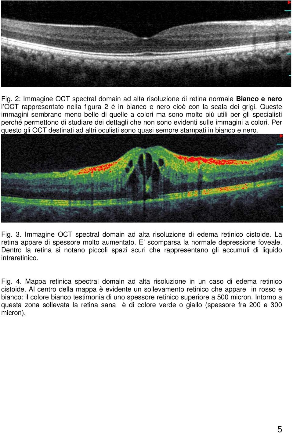 Per questo gli OCT destinati ad altri oculisti sono quasi sempre stampati in bianco e nero. Fig. 3. Immagine OCT spectral domain ad alta risoluzione di edema retinico cistoide.