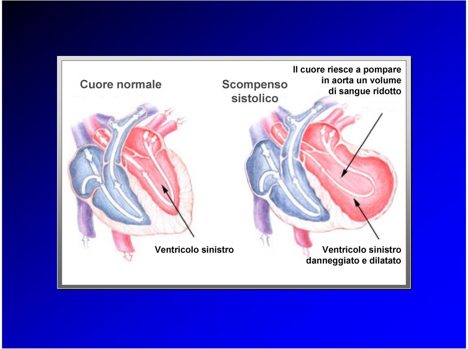 volume di sangue ridotto Ventricolo