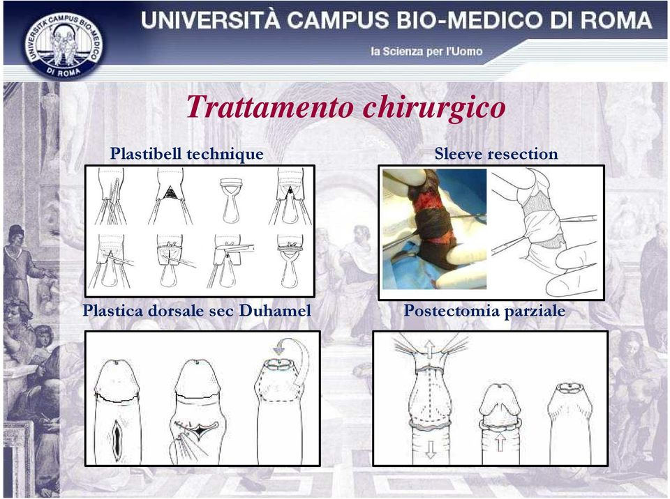 resection Plastica dorsale