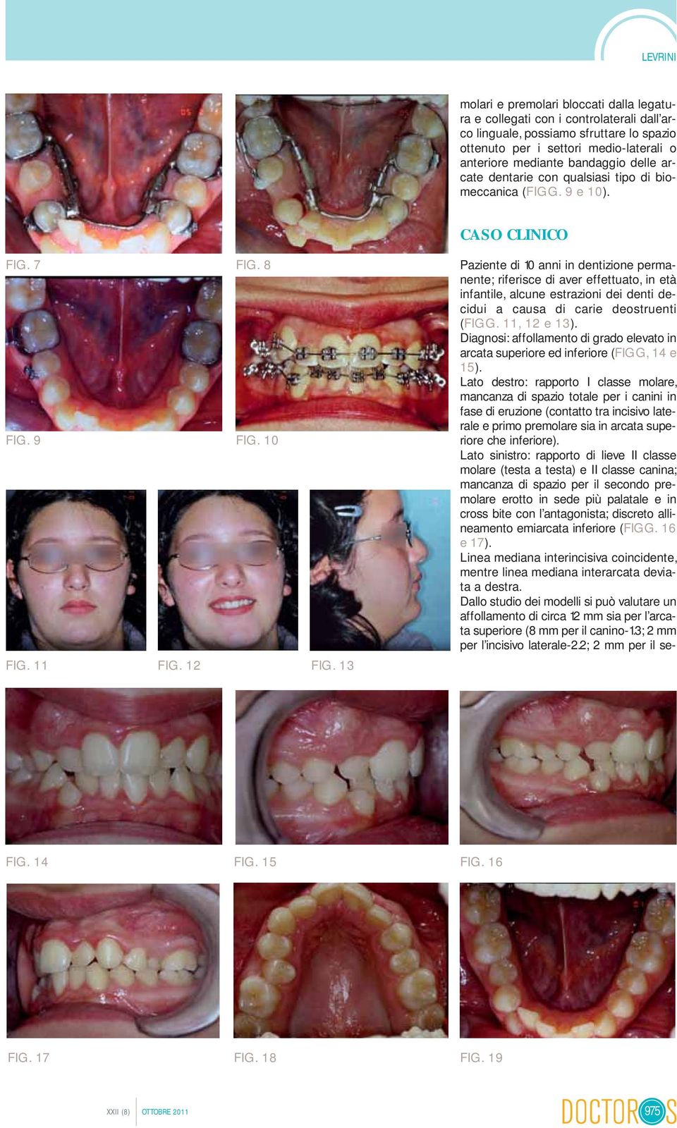 13 Paziente di 10 anni in dentizione permanente; riferisce di aver effettuato, in età infantile, alcune estrazioni dei denti decidui a causa di carie deostruenti (FIGG. 11, 12 e 13).