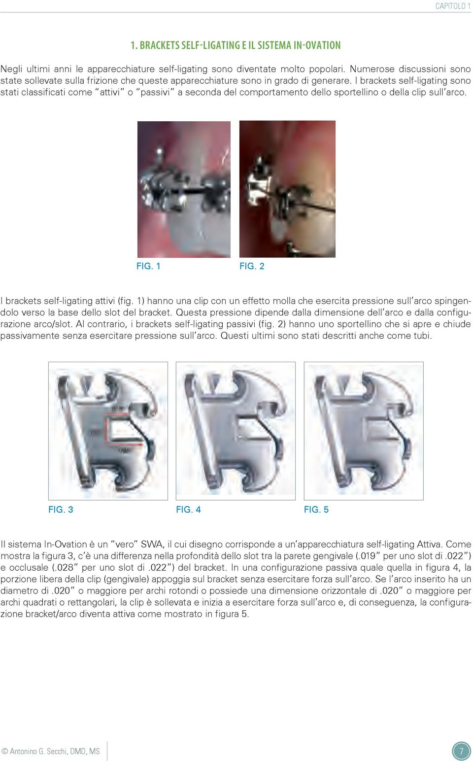 I brackets self-ligating sono stati classificati come attivi o passivi a seconda del comportamento dello sportellino o della clip sull arco. fig. 1 fig. 2 I brackets self-ligating attivi (fig.