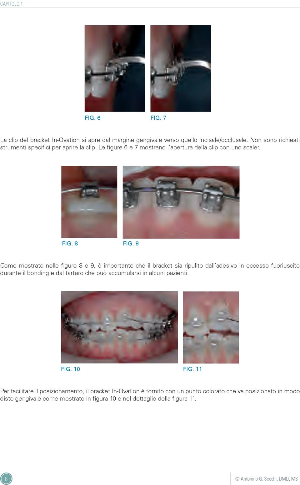 9 Come mostrato nelle figure 8 e 9, è importante che il bracket sia ripulito dall adesivo in eccesso fuoriuscito durante il bonding e dal tartaro che può accumularsi in