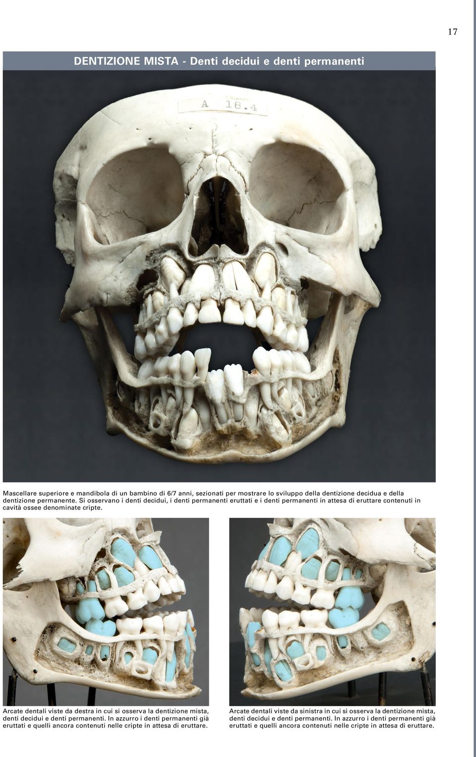 Arcate dentali viste da destra in cui si osserva la dentizione mista, denti decidui e denti permanenti.