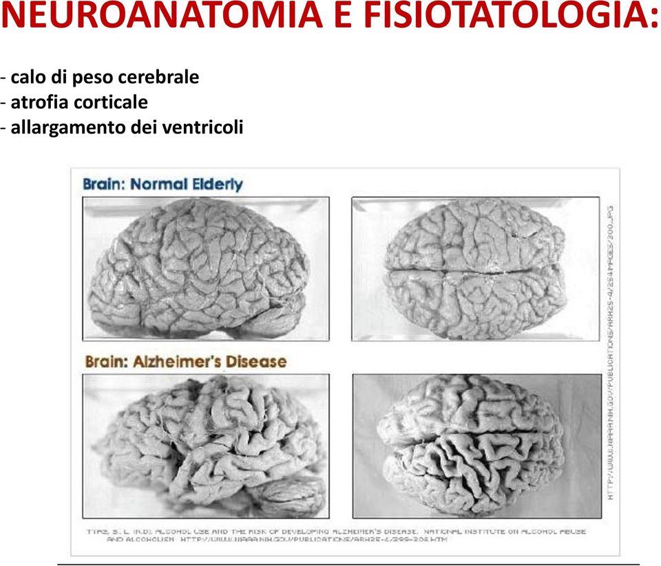 peso cerebrale - atrofia