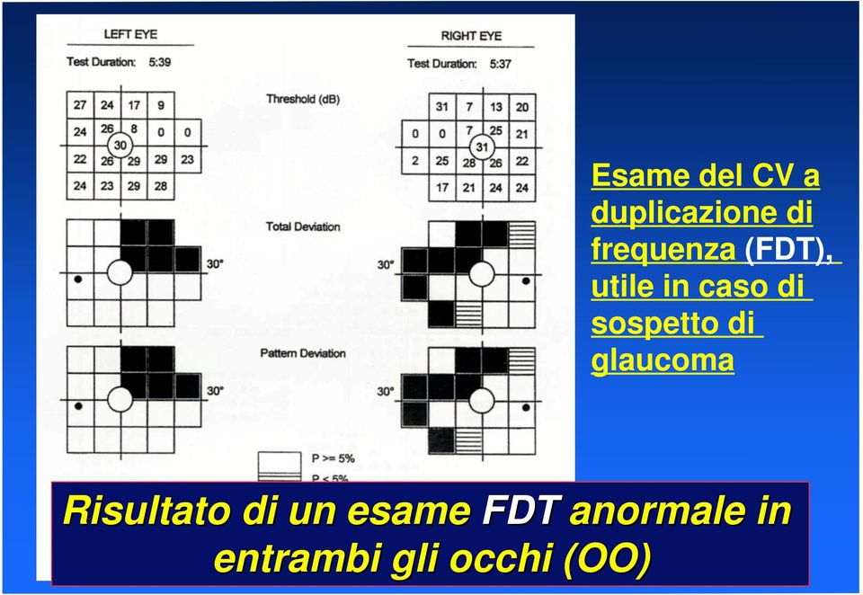 sospetto di glaucoma Risultato di un