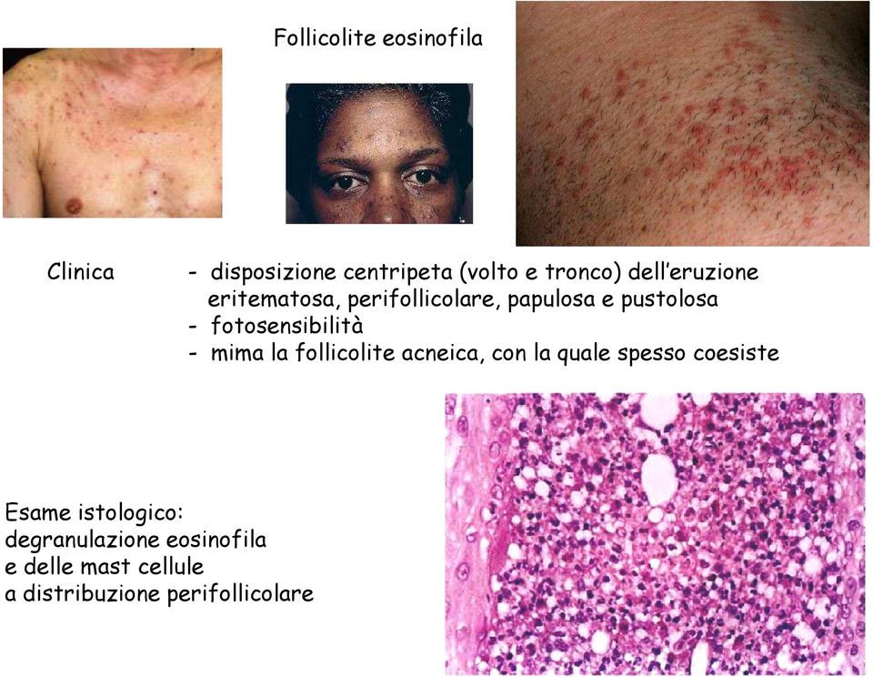 - mima la follicolite acneica, con la quale spesso coesiste Esame istologico: