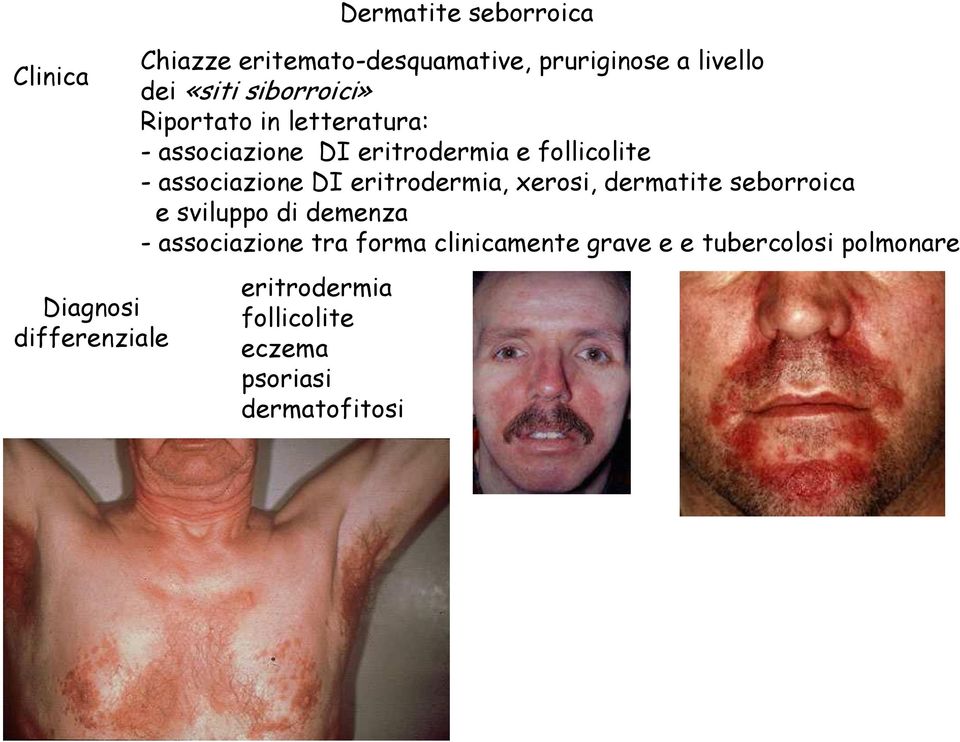 - associazione DI eritrodermia, xerosi, dermatite seborroica e sviluppo di demenza - associazione tra