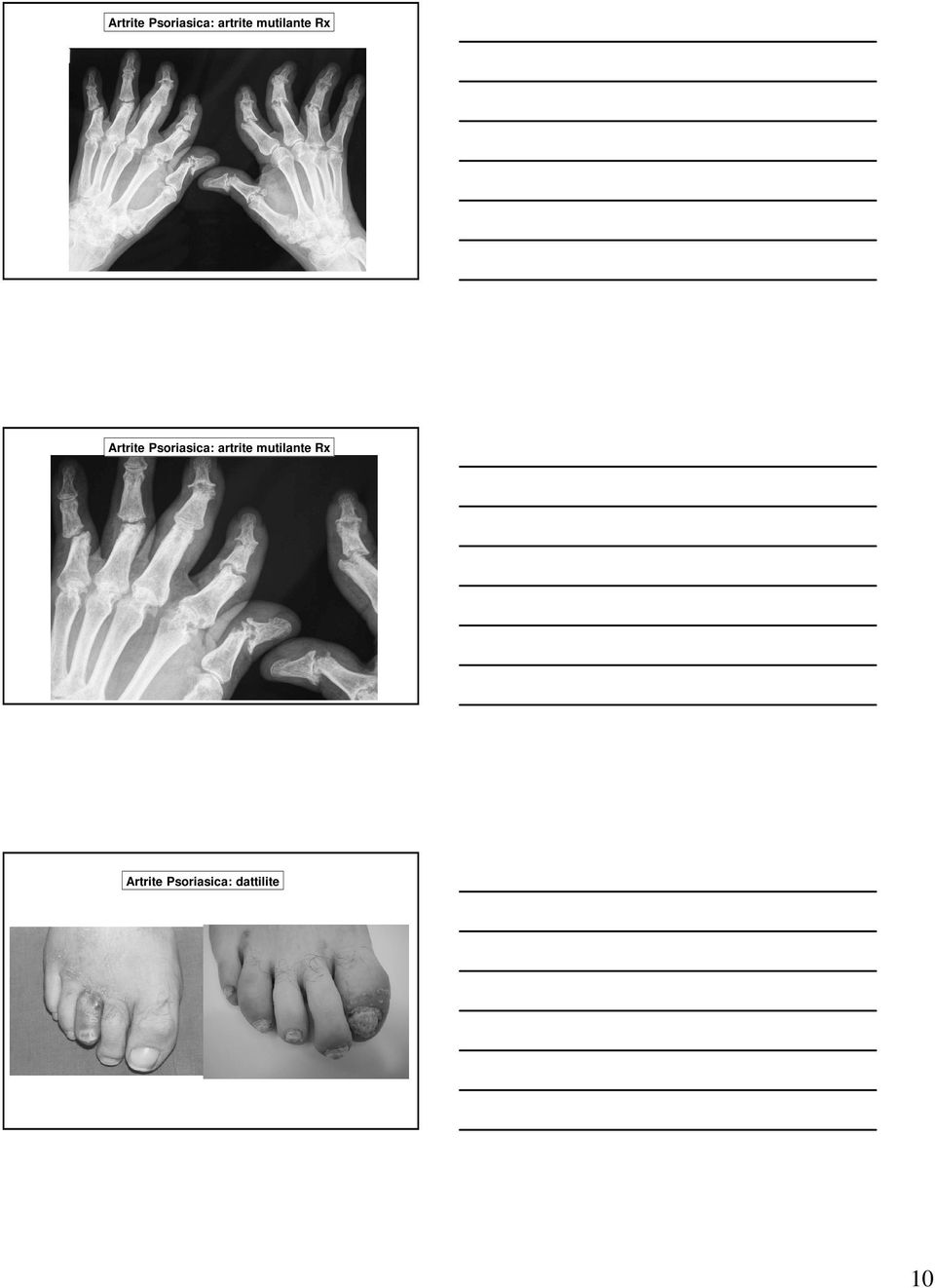 Artrite Psoriasica: