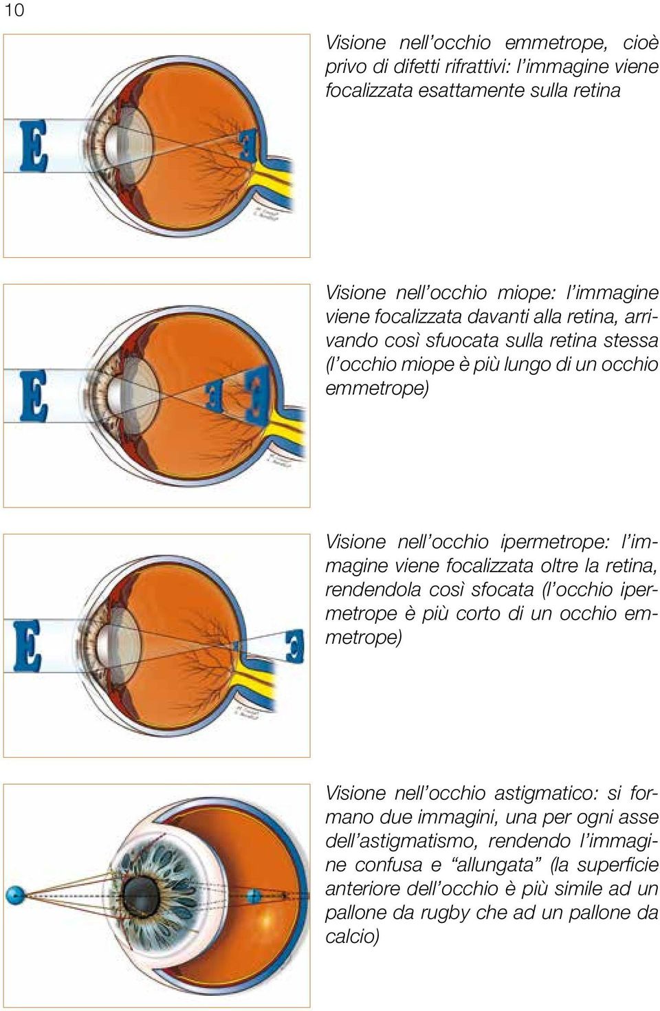 viene focalizzata oltre la retina, rendendola così sfocata (l occhio ipermetrope è più corto di un occhio emmetrope) Visione nell occhio astigmatico: si formano due