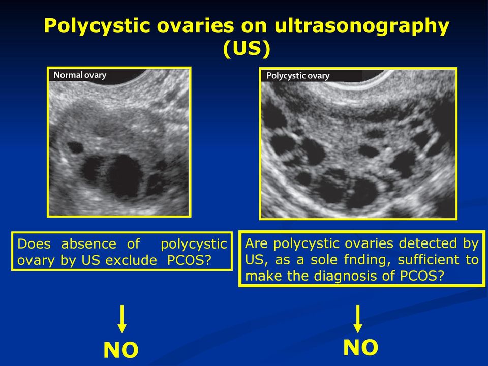 Are polycystic ovaries detected by US, as a sole