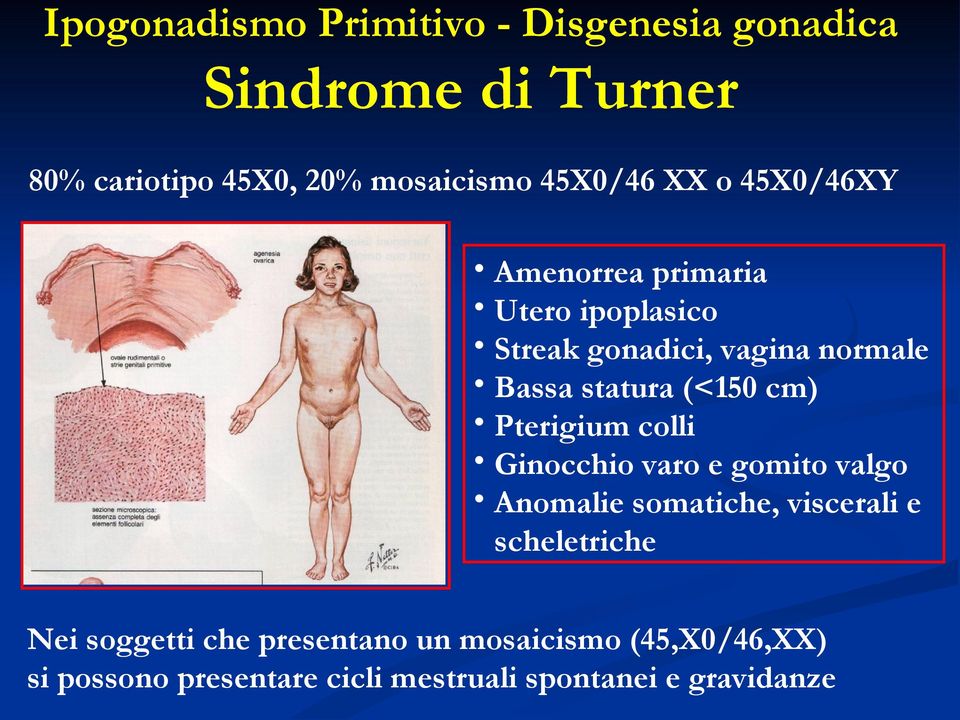 (<150 cm) Pterigium colli Ginocchio varo e gomito valgo Anomalie somatiche, viscerali e scheletriche Nei