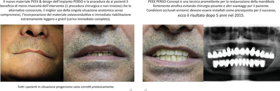 immediato completo). PEEK PERSO-Concept è una tecnica promettente per la restaurazione della mandibola fortemente atrofica evitando chirurgia pesante e altri svantaggi per il paziente.