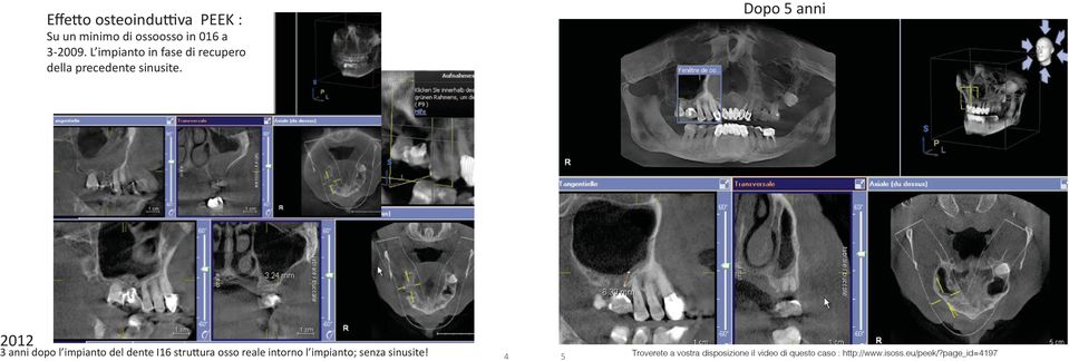 Dopo 5 anni 2012 3 anni dopo l impianto del dente I16 struttura osso reale intorno l