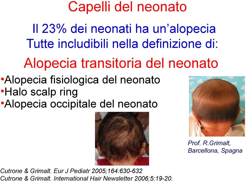 scalp ring Alopecia occipitale del neonato Prof. R.