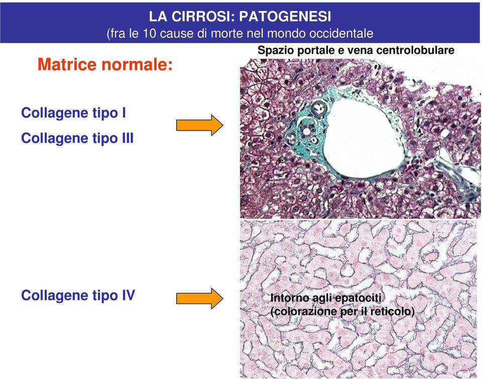 centrolobulare Collagene tipo I Collagene tipo III