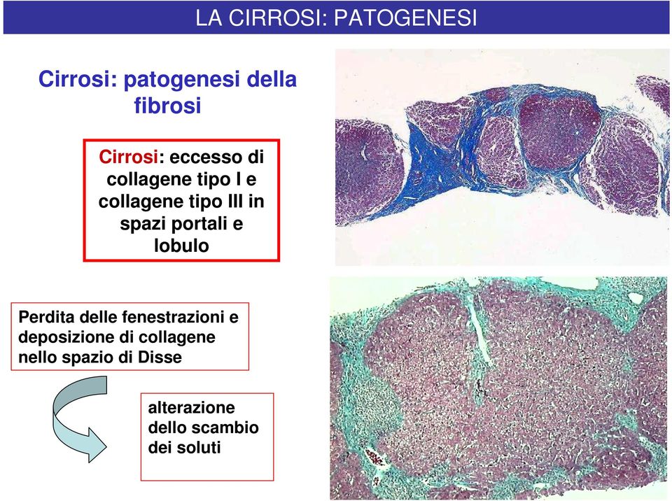 spazi portali e lobulo Perdita delle fenestrazioni e