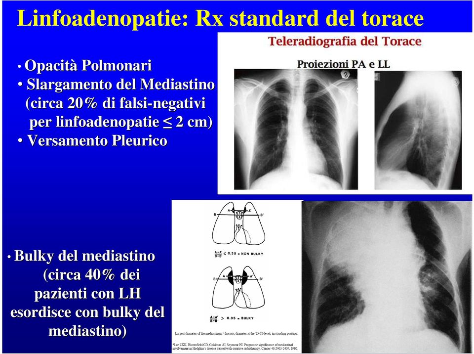 linfoadenopatie 2 cm) Versamento Pleurico Bulky del