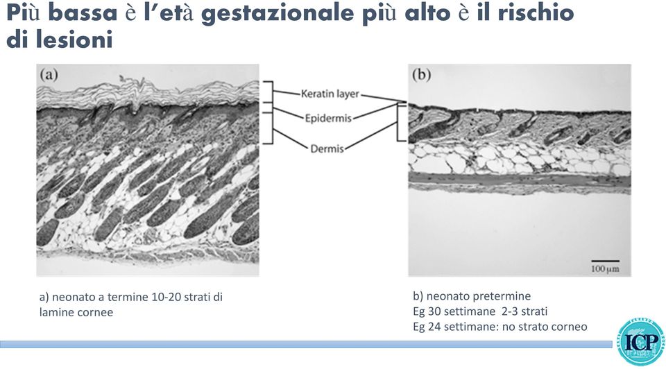 strati di lamine cornee b) neonato pretermine Eg