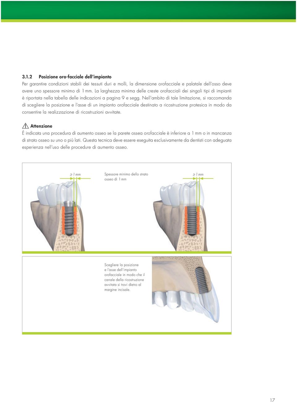 Nell ambito di tale limitazione, si raccomanda di scegliere la posizione e l asse di un impianto orofacciale destinato a ricostruzione protesica in modo da consentire la realizzazione di