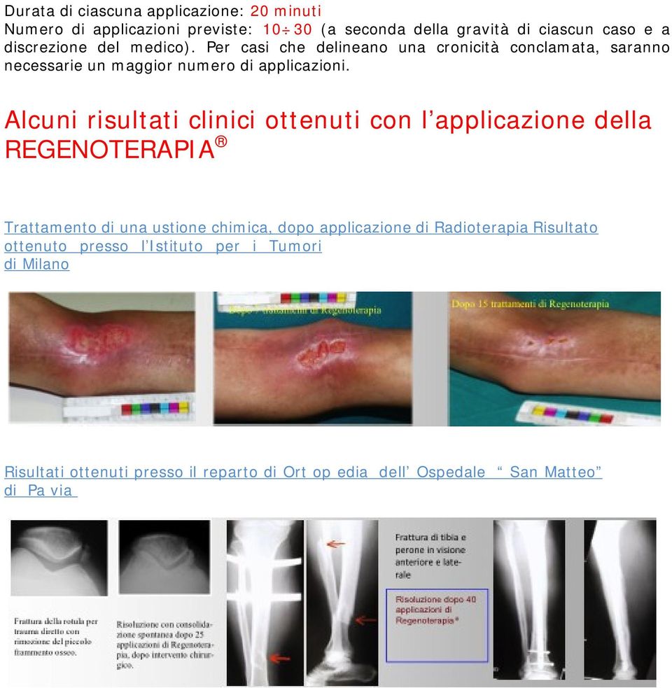 Alcuni risultati clinici ottenuti con l applicazione della REGENOTERAPIA Trattamento di una ustione chimica, dopo applicazione di