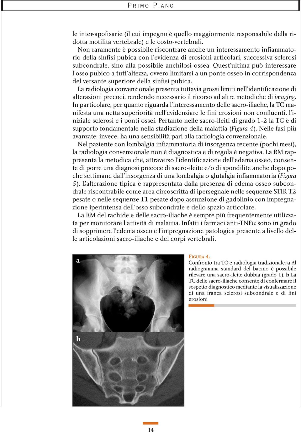 ossea. Quest ultima può interessare l osso pubico a tutt altezza, ovvero limitarsi a un ponte osseo in corrispondenza del versante superiore della sinfisi pubica.