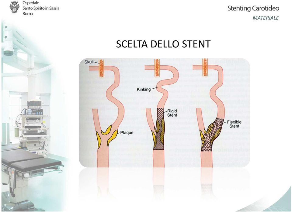 STENT