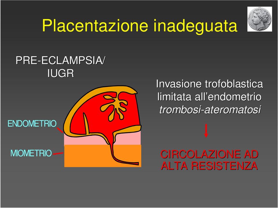 Invasione trofoblastica limitata all