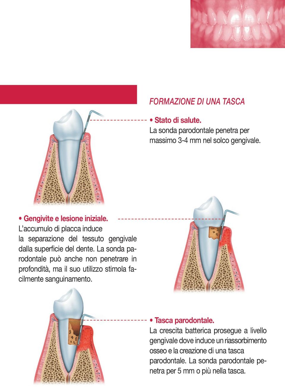 La sonda parodontale può anche non penetrare in profondità, ma il suo utilizzo stimola facilmente sanguinamento. Tasca parodontale.